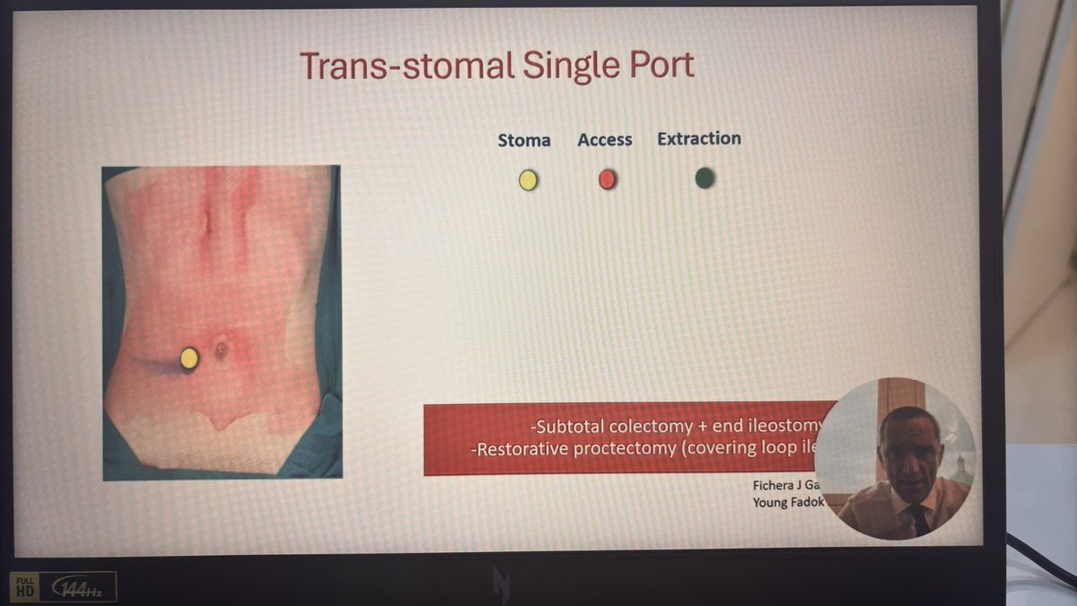 Dr AZHAR ATTAR (@attar_crsx) on Twitter photo Thank you <a href="/AntoninoSpin/">Antonino Spinelli</a> for the wonderful lecture on pouch surgeries…! <a href="/_ACRSI2025/">ACRSI OFFICIAL</a> <a href="/SWexner/">Steven D Wexner MD, PhD</a> <a href="/ACPGBI/">@ACPGBI</a> Thank you <a href="/AntoninoSpin/">Antonino Spinelli</a> for the wonderful lecture on pouch surgeries…! <a href="/_ACRSI2025/">ACRSI OFFICIAL</a> <a href="/SWexner/">Steven D Wexner MD, PhD</a> <a href="/ACPGBI/">@ACPGBI</a>