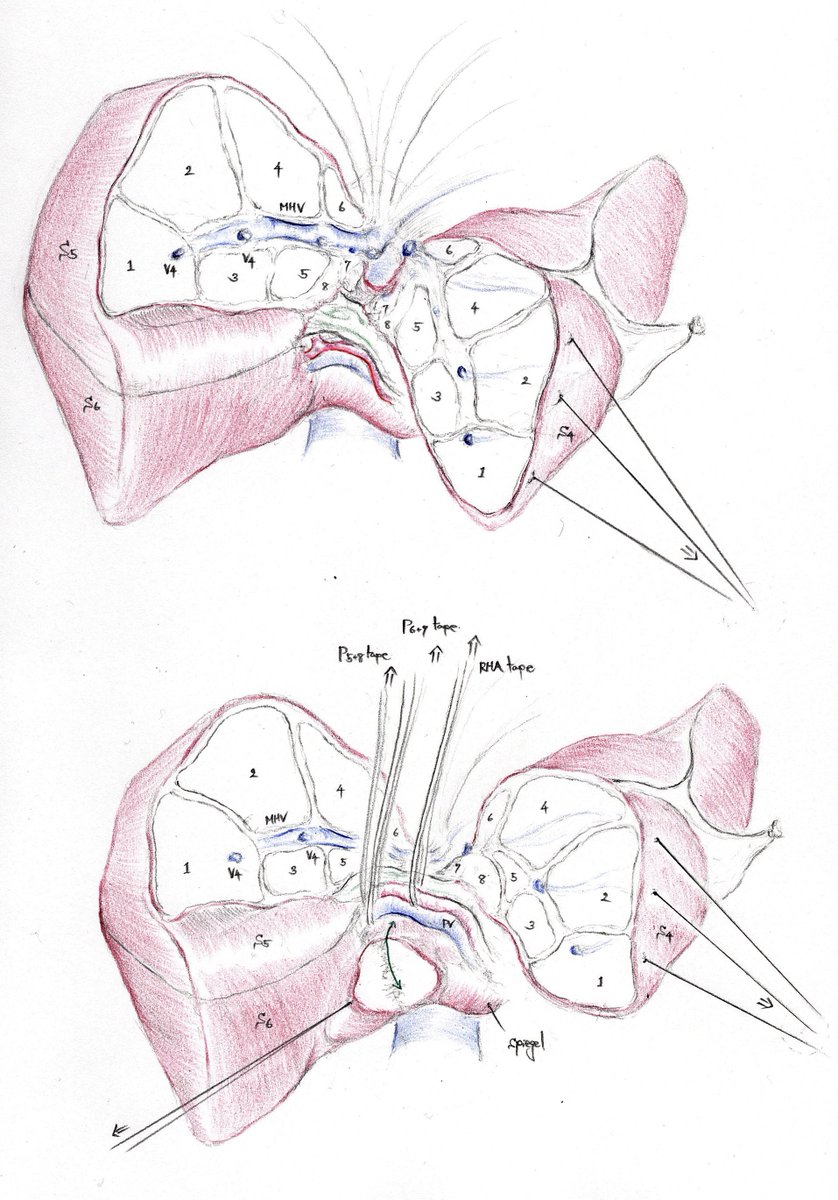 左葉切除＋尾状葉切除のオペレコの一部

中肝静脈の尾状葉枝を尾側に切っていき、右グリソンの前の実質も離断。

尾側から突起部を離断し、右グリソンをテーピング