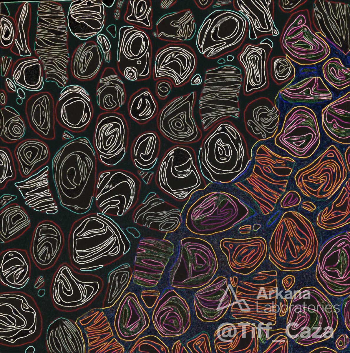 Arkana Laboratories (@arkanalabs) on Twitter photo This painting by <a href="/Tiff_Caza/">Tiffany Caza</a> shows myelinosomes, also known as “zebra bodies” for their appearance on tangential sectioning. Myelinosomes are seen in Fabry disease, a rare x-linked recessive genetic disorder caused by defective activity of the enzyme alpha-galactosidase A. This painting by <a href="/Tiff_Caza/">Tiffany Caza</a> shows myelinosomes, also known as “zebra bodies” for their appearance on tangential sectioning. Myelinosomes are seen in Fabry disease, a rare x-linked recessive genetic disorder caused by defective activity of the enzyme alpha-galactosidase A.