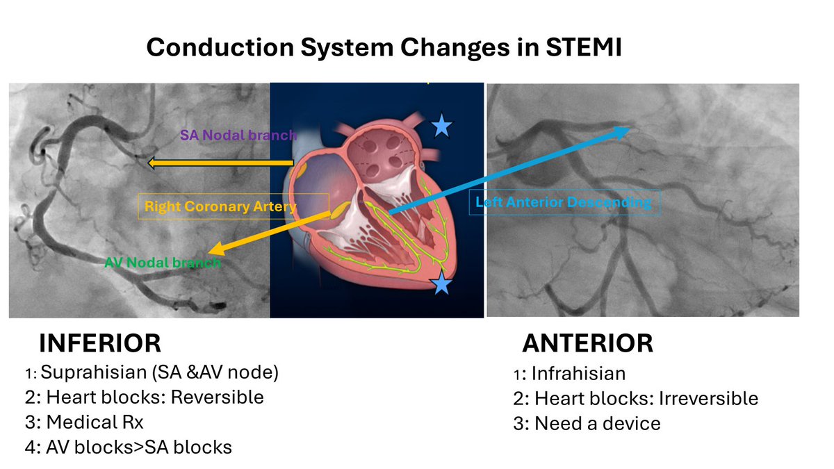 Cardiac conduction system involvement in STEMI
Now we know why AV blocks in inferior STEMI are more common than SA blocks.