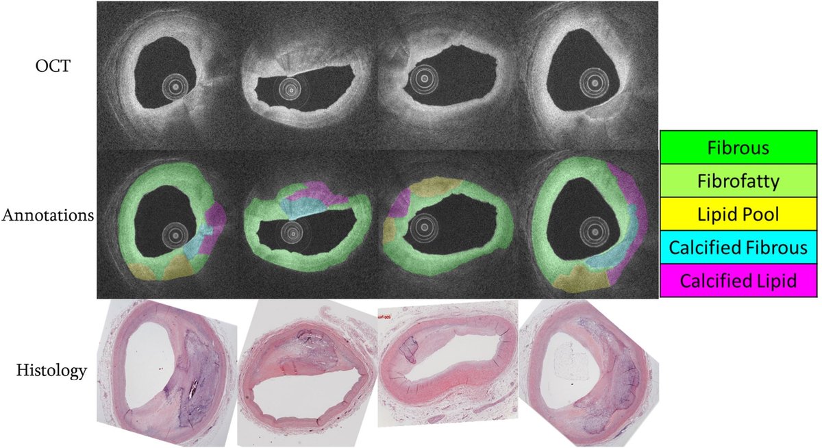 MyJSCAI's tweet photo. 📚Histology-grounded segmentation algorithm to detect #plaque subtypes in #coronary #IVOCT scans. Histology co-registration helps ensure accuracy of truth! #AI #Atherosclerosis

➡️https://t.co/x6GJ7t4nvY 

@MdFeldman https://t.co/xNqtK2VC1R