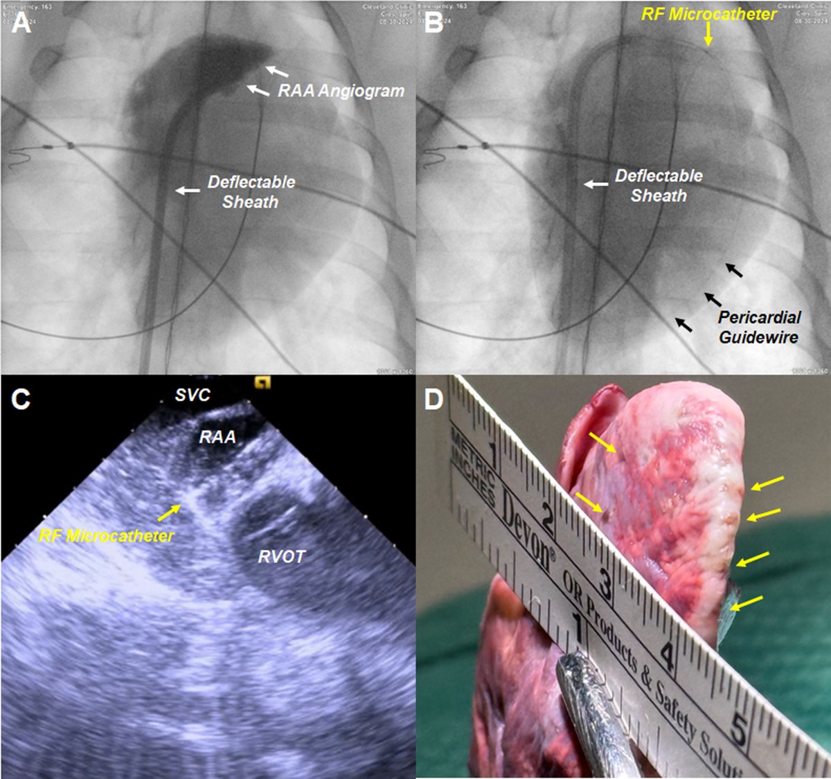Dr_Santangeli's tweet image. A Dedicated Radiofrequency Microcatheter Assembly For Trans-Right Atrial Appendage Pericardial Carbon Dioxide Insufflation To Facilitate Epicardial Access @CleClinicHVTI @CCInnovations @ioanliuba @arwayounis2 @tavrkapadia  @omwazni

heartrhythmjournal.com/article/S1547-…