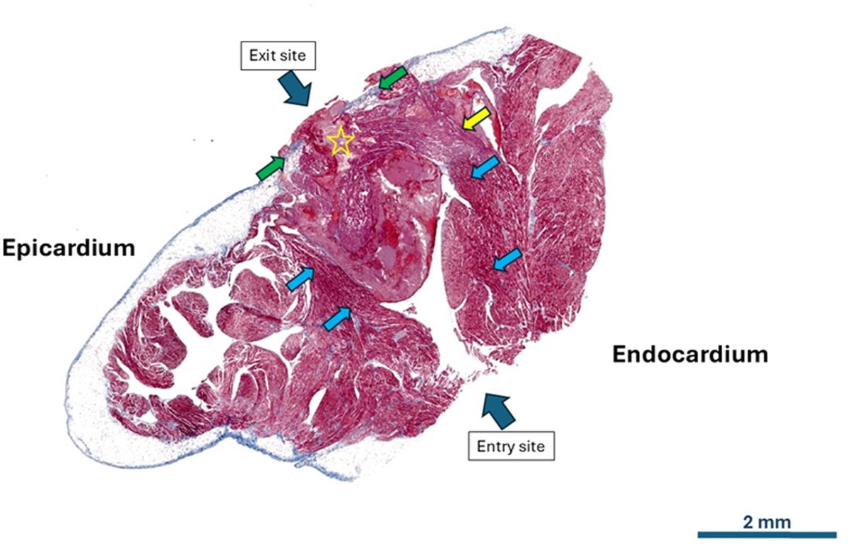 Pasquale Santangeli (@dr_santangeli) on Twitter photo A Dedicated Radiofrequency Microcatheter Assembly For Trans-Right Atrial Appendage Pericardial Carbon Dioxide Insufflation To Facilitate Epicardial Access <a href="/CleClinicHVTI/">Cleveland Clinic Heart, Vascular & Thoracic</a> <a href="/CCInnovations/">CCInnovations</a> <a href="/ioanliuba/">Ioan Liuba</a> <a href="/arwayounis2/">Arwa Younis MD</a> <a href="/tavrkapadia/">Samir Kapadia</a> <a href="/omwazni/">Oussama Wazni</a>
heartrhythmjournal.com/article/S1547-… A Dedicated Radiofrequency Microcatheter Assembly For Trans-Right Atrial Appendage Pericardial Carbon Dioxide Insufflation To Facilitate Epicardial Access <a href="/CleClinicHVTI/">Cleveland Clinic Heart, Vascular & Thoracic</a> <a href="/CCInnovations/">CCInnovations</a> <a href="/ioanliuba/">Ioan Liuba</a> <a href="/arwayounis2/">Arwa Younis MD</a> <a href="/tavrkapadia/">Samir Kapadia</a> <a href="/omwazni/">Oussama Wazni</a>
heartrhythmjournal.com/article/S1547-…
