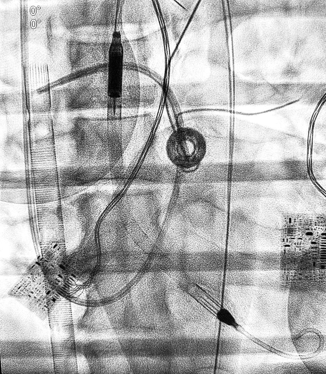 EC-Pella for Refractory Cardiogenic⚡️🫀💥Shock: This Is The Way…
