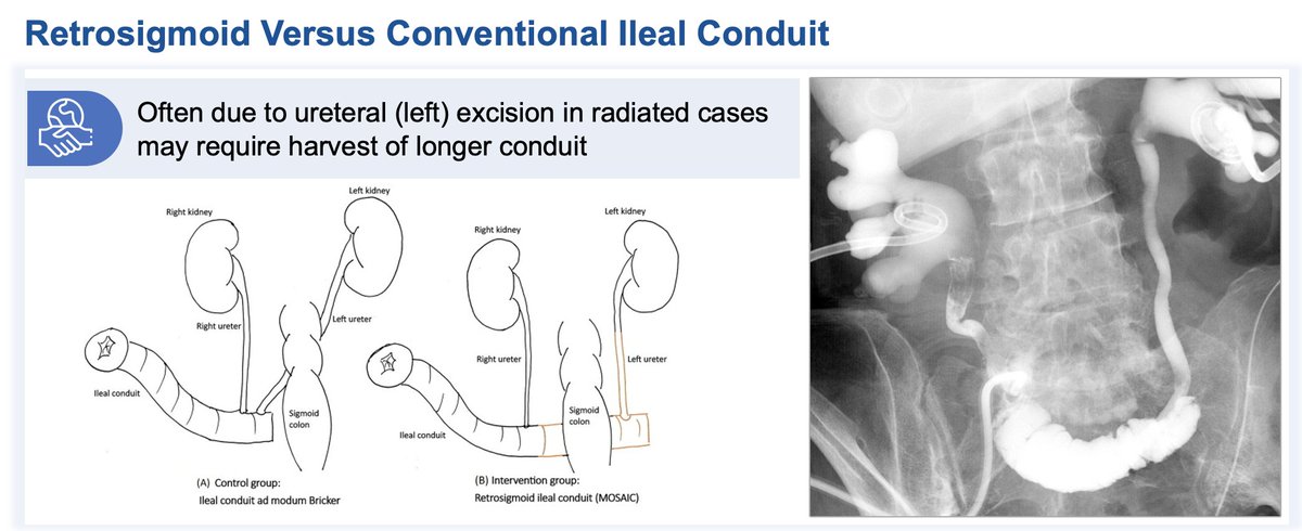 Big fan of the retrosigmoid ileal conduit (MOSAIC) in radiated patients especially when the left ureter is compromised/short. Elegant solution, great outcomes, no reabsorption toxicity.  #bladdercancer Some light reading here  📖➡️eu-openscience.europeanurology.com/article/S2666-…  #bladdercancer