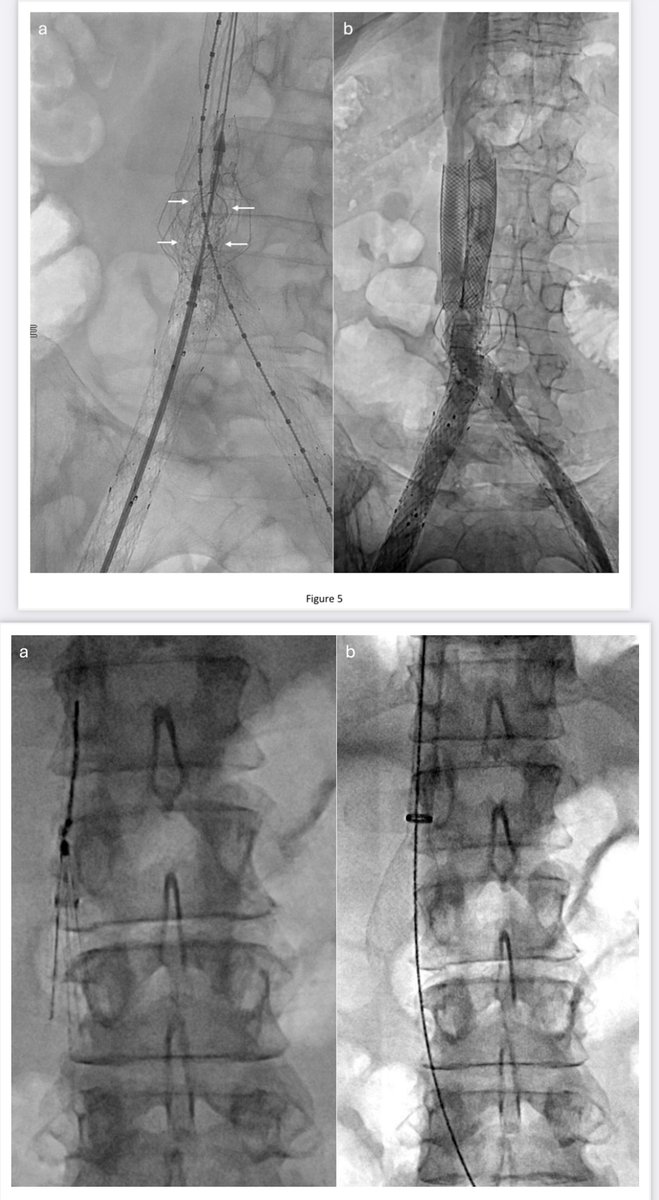 Jeffrey F. B. Chick, MD, MPH (@chickvir) on Twitter photo Itโs an exciting time to be a venous specialist! This article provides a summary of the venous thrombectomy device landscape, highlighting expanding clinical applications.
clinicalimaging.org/article/S0899-โฆ
<a href="/USC_IR/">USC IR</a> <a href="/UWRadiology/">UW Radiology</a> <a href="/clinicalimaging/">clinical imaging</a> <a href="/JVIRmedia/">JVIR</a> <a href="/cvirendo/">CVIR Endovascular (Jim Reekers, Editor-in-Chief)</a> <a href="/cvirendo/">CVIR Endovascular (Jim Reekers, Editor-in-Chief)</a> Itโs an exciting time to be a venous specialist! This article provides a summary of the venous thrombectomy device landscape, highlighting expanding clinical applications.
clinicalimaging.org/article/S0899-โฆ
<a href="/USC_IR/">USC IR</a> <a href="/UWRadiology/">UW Radiology</a> <a href="/clinicalimaging/">clinical imaging</a> <a href="/JVIRmedia/">JVIR</a> <a href="/cvirendo/">CVIR Endovascular (Jim Reekers, Editor-in-Chief)</a> <a href="/cvirendo/">CVIR Endovascular (Jim Reekers, Editor-in-Chief)</a>