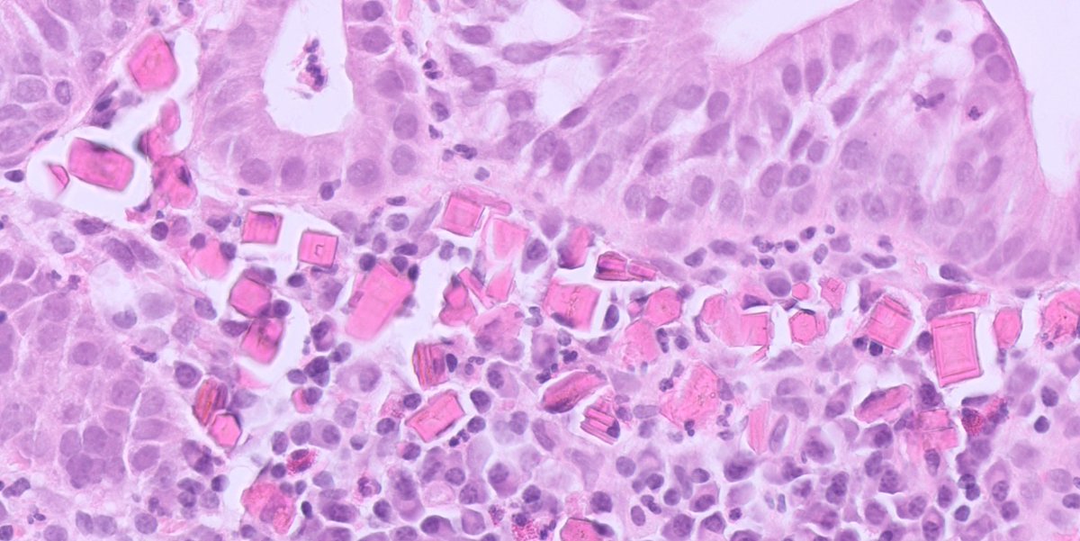 A benign cervical polyp with crystals 🤣👇👇👇
#gynpath #PathTwitter