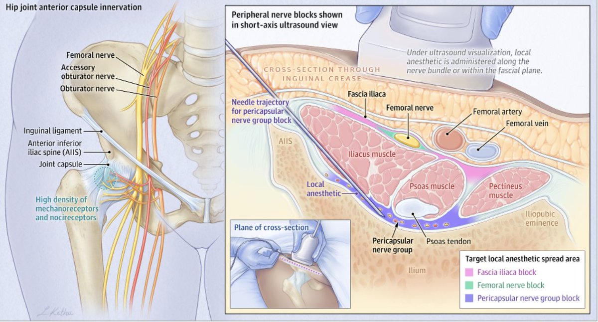 Eva Tovar Hirashima MD MPH (@evath_em) on Twitter photo Muy buen resumen gráfico/escrito de bloqueos guiados por US para fracturas de cadera en donde soy coautora 🤓😎. Revisen y compartan! Sigamos <a href="/UPAndo6/">UPAndo</a>!! 🎇🎆
<a href="/upadelnorte/">UPA del Norte</a> <a href="/californiaacep/">California ACEP</a> <a href="/WINFOCUS/">WINFOCUS WORLD</a> <a href="/SAEMonline/">SAEM</a> <a href="/ACEP_EUS/">ACEP Ultrasound</a> <a href="/Dr_Insonando/">Alex_RG</a>
jamanetwork.com/journals/jama/… Muy buen resumen gráfico/escrito de bloqueos guiados por US para fracturas de cadera en donde soy coautora 🤓😎. Revisen y compartan! Sigamos <a href="/UPAndo6/">UPAndo</a>!! 🎇🎆
<a href="/upadelnorte/">UPA del Norte</a> <a href="/californiaacep/">California ACEP</a> <a href="/WINFOCUS/">WINFOCUS WORLD</a> <a href="/SAEMonline/">SAEM</a> <a href="/ACEP_EUS/">ACEP Ultrasound</a> <a href="/Dr_Insonando/">Alex_RG</a>
jamanetwork.com/journals/jama/…