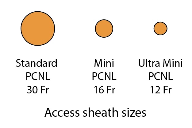St. Luke's Health MD (@stlukeshealthmd) on Twitter photo Percutaneous nephrostolithotomy (PCNL) dramatically improves treatment of large kidney stones. <a href="/bcm_urology/">BCM Department of Urology</a> and <a href="/StLukesHealthMD/">St. Luke's Health MD</a> endourologists are pioneers in using mini and ultra mini PCNL instruments, offering this advanced surgery with same day discharge. Percutaneous nephrostolithotomy (PCNL) dramatically improves treatment of large kidney stones. <a href="/bcm_urology/">BCM Department of Urology</a> and <a href="/StLukesHealthMD/">St. Luke's Health MD</a> endourologists are pioneers in using mini and ultra mini PCNL instruments, offering this advanced surgery with same day discharge.