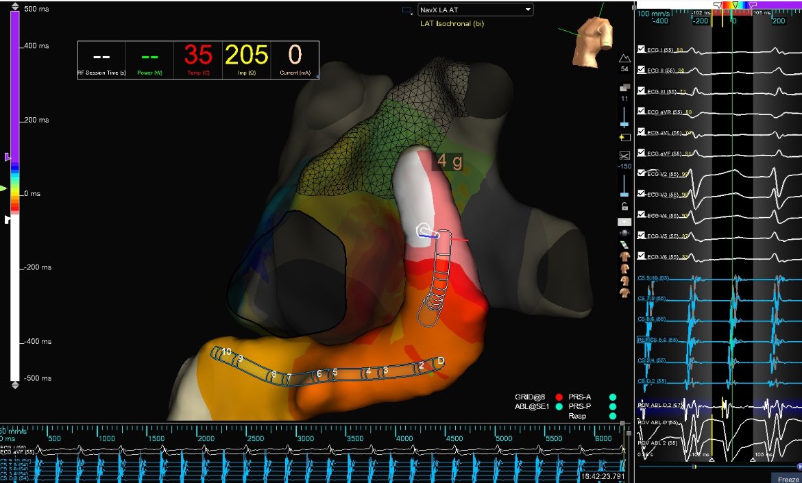 EPbytheBay's tweet photo. AT mapped to the lateral mitral isthmus (Rachel Willis). Distal CS signals preceded all LA signals. Notice signal change as the ablator subselects the vein of Marshall (imp. to 200+ ohms). VOM alcohol ablation terminated rhythm. Case performed by Dr. Cain at St. Helena Hospital https://t.co/azcABu7amh