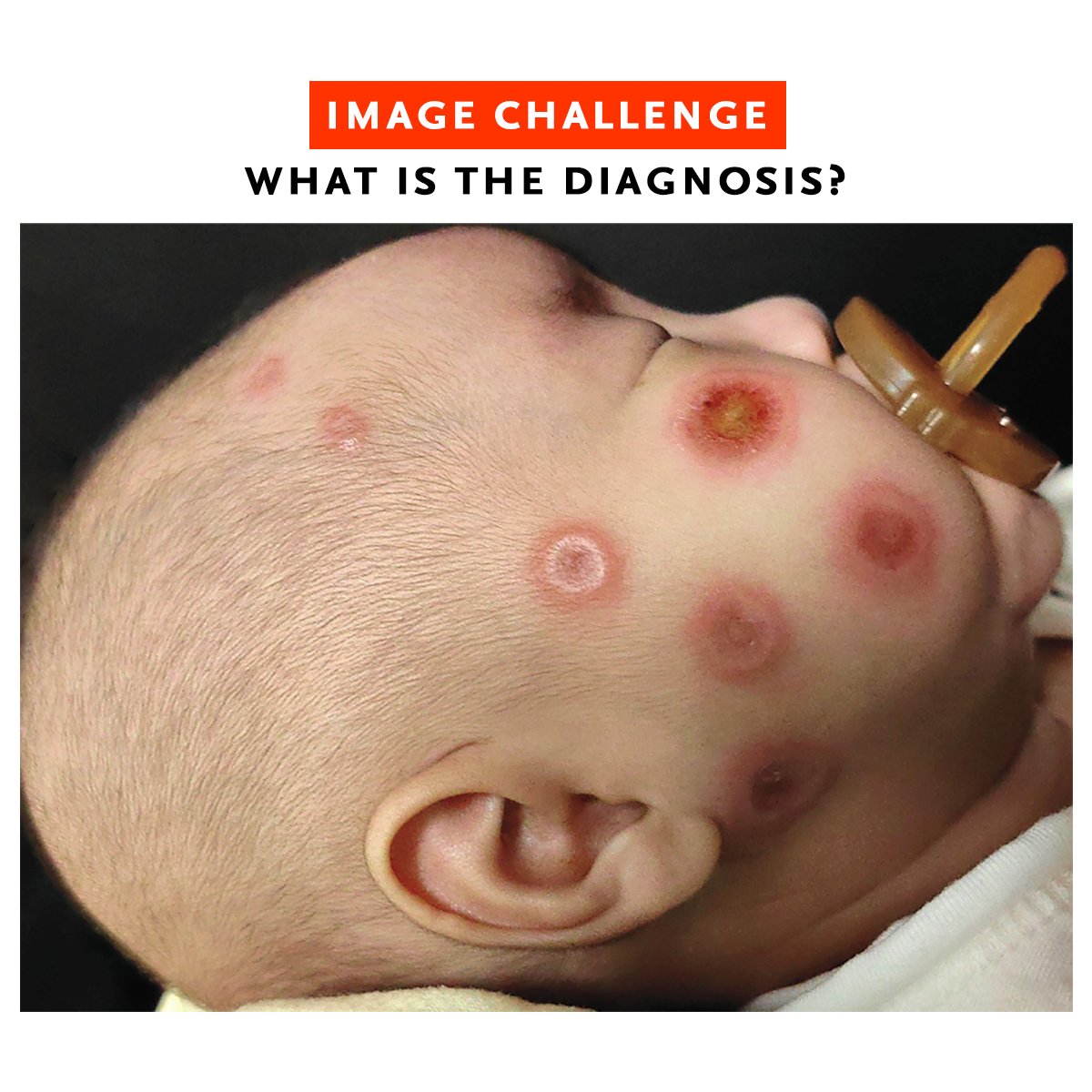 A previously healthy, full-term, 2-month-old boy was brought to the dermatology clinic with a 2-week history of annular plaques with edematous borders and central crusting on the face, scalp, and trunk. Results of a complete blood count and comprehensive metabolic panel were