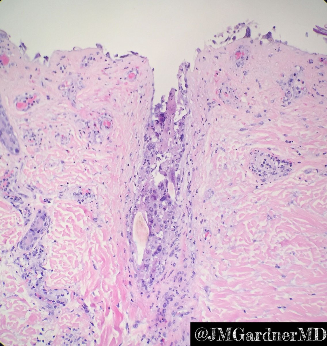 Painful erythematous rash on trunk in elderly patient. Diagnosis? 
Answer ✅ youtu.be/pDDKogUoJ5Y
#pathology #pathologists #pathTwitter #dermpath #dermatology #dermatologia #dermtwitter #usmle
