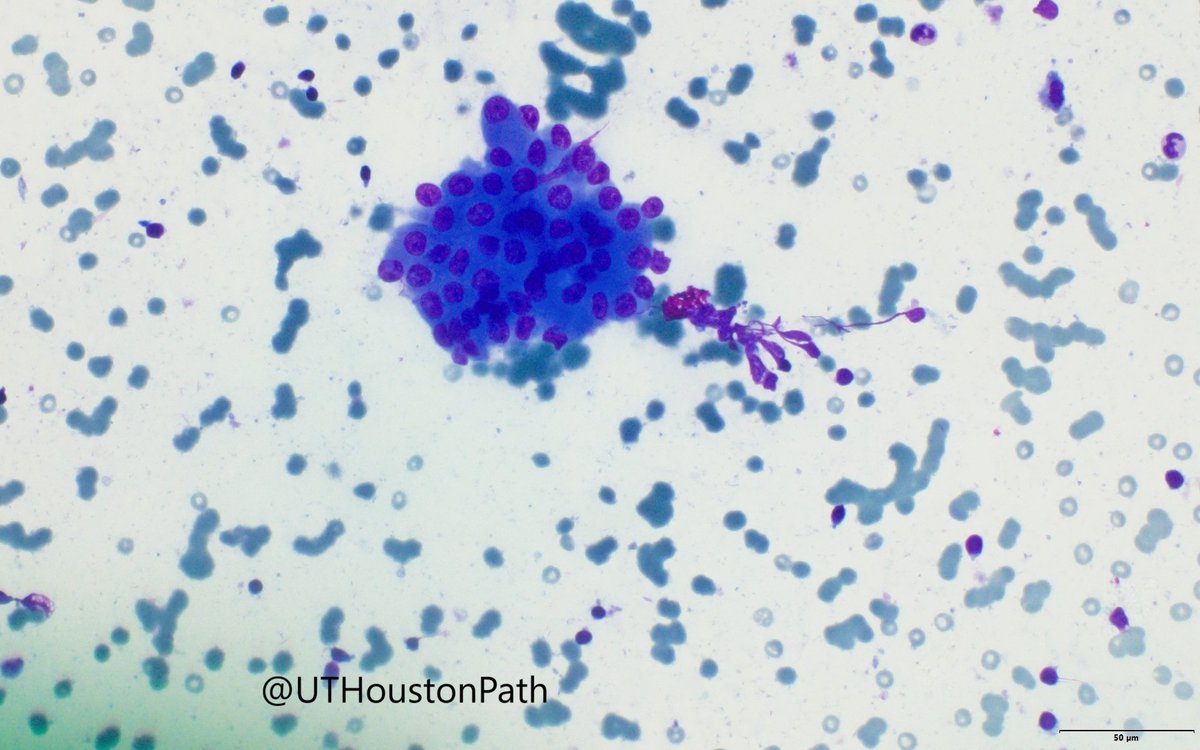 What is the most likely diagnosis for this salivary gland FNA? #cytology #cytopath #PathX #PathTwitter <a href="/YasirAli_MD/">Yasir Ali</a>