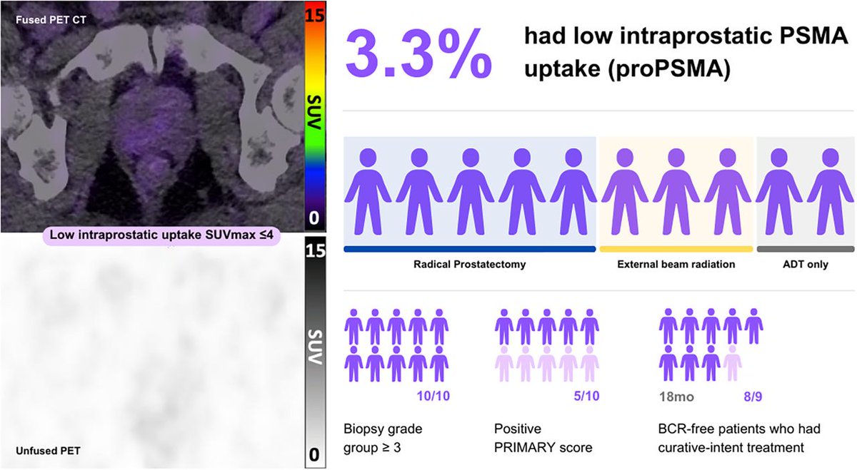 Michael Hofman (@drmhofman) on Twitter photo ... how common is PSMA-negative significant prostate
cancer? In the proPSMA study it was 3.3%
Hot of the press in <a href="/JournalofNucMed/">JNM</a>: jnm.snmjournals.org/content/early/…
Wonderful work from <a href="/davcmed/">David Chen</a> and team <a href="/pros_tic/">ProsTIC</a> including <a href="/ButeauJames/">James Buteau</a> <a href="/declangmurphy/">Declan Murphy</a> ... how common is PSMA-negative significant prostate
cancer? In the proPSMA study it was 3.3%
Hot of the press in <a href="/JournalofNucMed/">JNM</a>: jnm.snmjournals.org/content/early/…
Wonderful work from <a href="/davcmed/">David Chen</a> and team <a href="/pros_tic/">ProsTIC</a> including <a href="/ButeauJames/">James Buteau</a> <a href="/declangmurphy/">Declan Murphy</a>