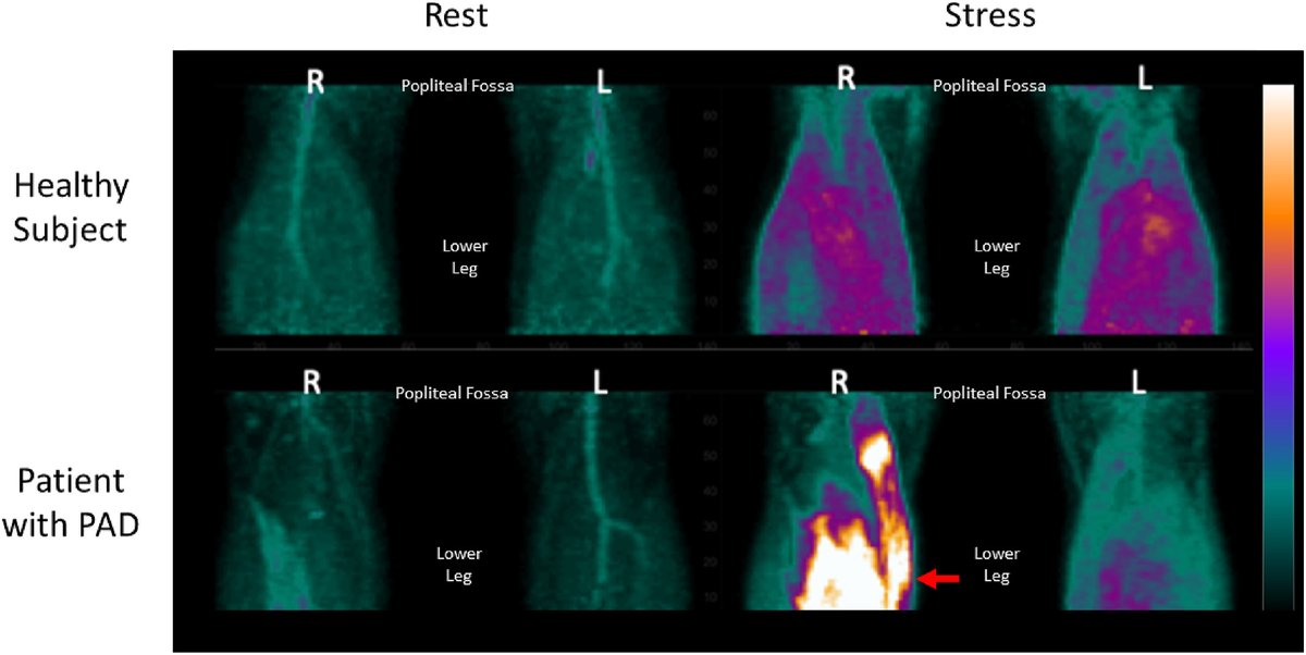 Journal of Nuclear Cardiology (@jncjournal) on Twitter photo In a study of healthy subjects and patients with PAD involving perfusion PET/CT, skeletal muscle blood flow increased post-exercise to the greatest degree in the symptomatic legs of patients with PAD. <a href="/sanjaydivakaran/">Sanjay Divakaran</a> <a href="/mdicarli/">Marcelo Di Carli</a> <a href="/BWHCVImaging/">Brigham and Women’s Cardiovascular Imaging Program</a>
Read now👉bit.ly/3FGIRZX In a study of healthy subjects and patients with PAD involving perfusion PET/CT, skeletal muscle blood flow increased post-exercise to the greatest degree in the symptomatic legs of patients with PAD. <a href="/sanjaydivakaran/">Sanjay Divakaran</a> <a href="/mdicarli/">Marcelo Di Carli</a> <a href="/BWHCVImaging/">Brigham and Women’s Cardiovascular Imaging Program</a>
Read now👉bit.ly/3FGIRZX