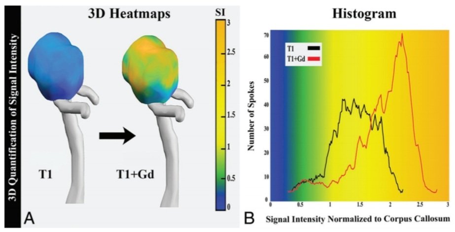 Carlos Dier (@dier_carlos) on Twitter photo Visual assessment of aneurysm wall enhancement is prone to variability. Objective quantification provides a reliable approach, especially for large or multiple aneurysms <a href="/esamaniego/">Edgar A Samaniego P</a>
<a href="/IowaVascular/">Iowa Vascular</a> <a href="/IowaRAD/">University of Iowa Radiology</a> <a href="/TheAJNR/">AJNR</a>
ajnr.org/content/early/… Visual assessment of aneurysm wall enhancement is prone to variability. Objective quantification provides a reliable approach, especially for large or multiple aneurysms <a href="/esamaniego/">Edgar A Samaniego P</a>
<a href="/IowaVascular/">Iowa Vascular</a> <a href="/IowaRAD/">University of Iowa Radiology</a> <a href="/TheAJNR/">AJNR</a>
ajnr.org/content/early/…