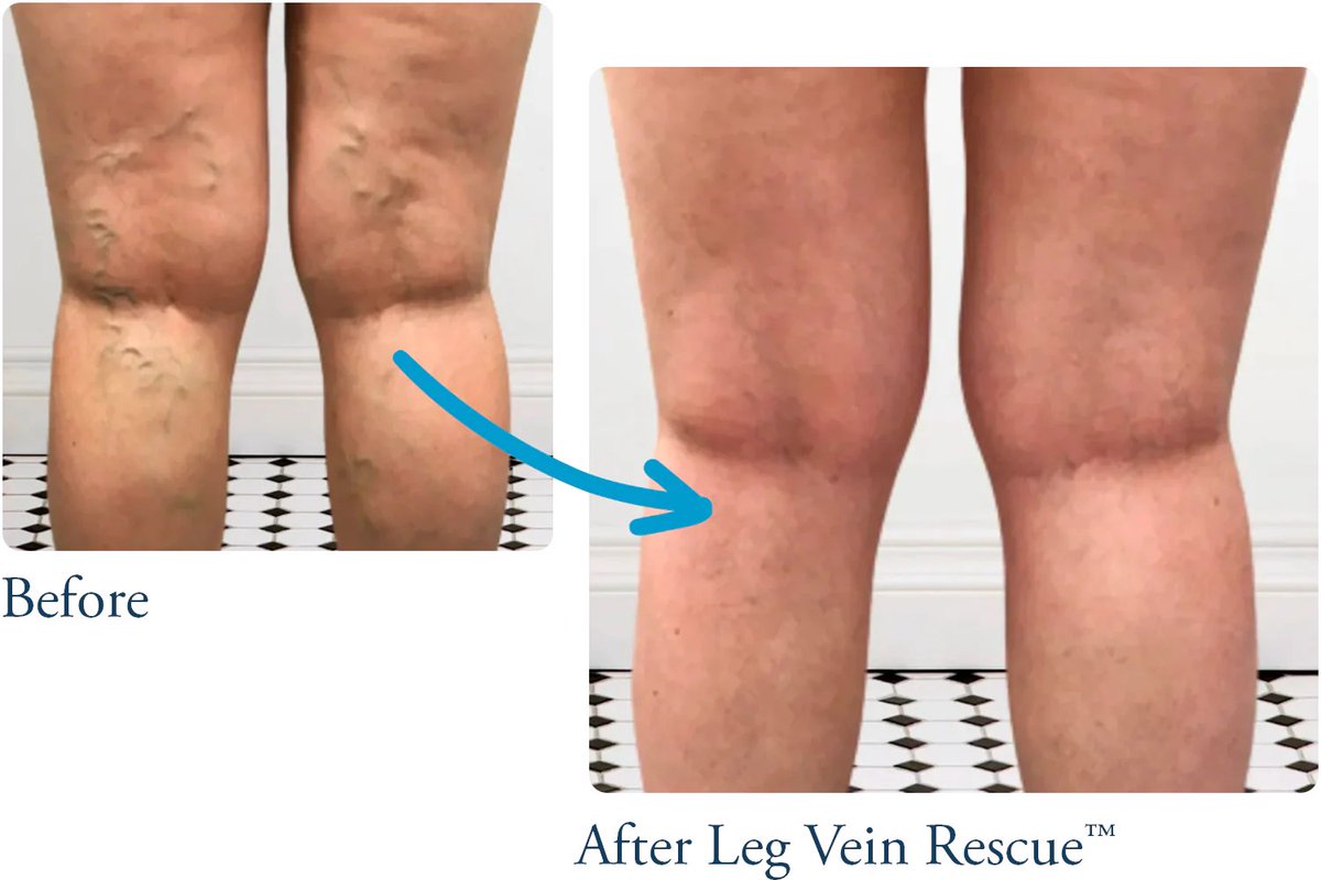 Helenanelson16's tweet image. Support circulation and reduce discomfort with Leg Vein Rescue! Our natural formula promotes leg vein health, reducing swelling and improving vascular function. Visit Now: legveinrescue.com/pages/about-us

#LegVeinHealth #CirculationSupport #VeinCare