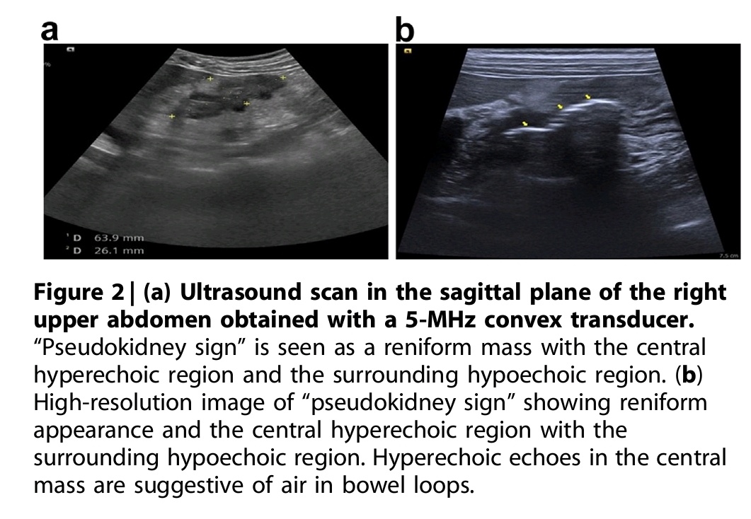 Gopambuj Singh Rathod (@iamgopambuj) on Twitter photo A child referred for evaluation having "3 kidneys" !!!!
🔅What is this 3rd kidney?
🔆Is it really a kidney or a "pseudokidney"?
📝An interesting short read in the latest <a href="/Kidney_Int/">Kidney International</a> from <a href="/sidsdoc/">sidsdoc</a> sir <a href="/drshyambansal/">Shyam Bansal</a> sir and team.
#Radiology #Kidney #NephX #MedTwitter #GSR A child referred for evaluation having "3 kidneys" !!!!
🔅What is this 3rd kidney?
🔆Is it really a kidney or a "pseudokidney"?
📝An interesting short read in the latest <a href="/Kidney_Int/">Kidney International</a> from <a href="/sidsdoc/">sidsdoc</a> sir <a href="/drshyambansal/">Shyam Bansal</a> sir and team.
#Radiology #Kidney #NephX #MedTwitter #GSR