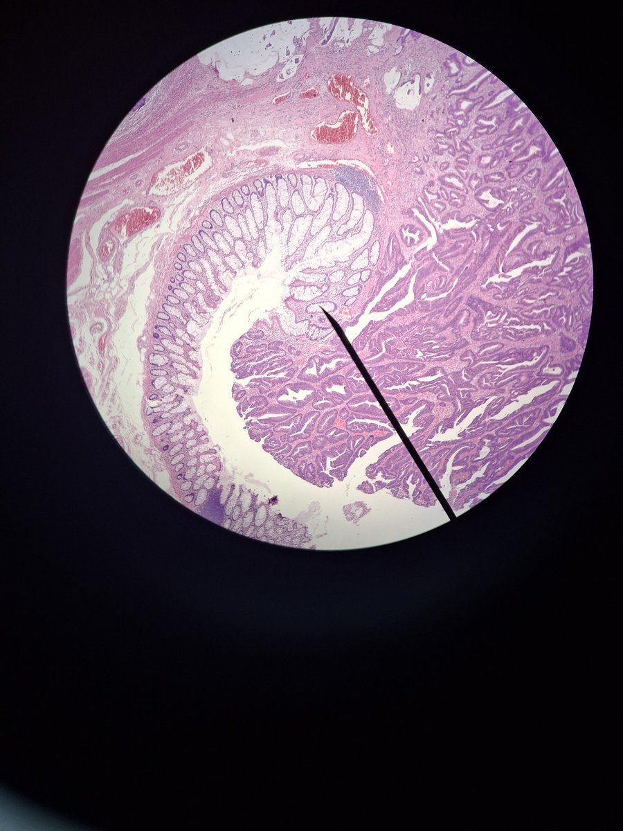 Adenocarcinoma ใน organ สักอย่าง ( neoplasia ฟินสุดละ)