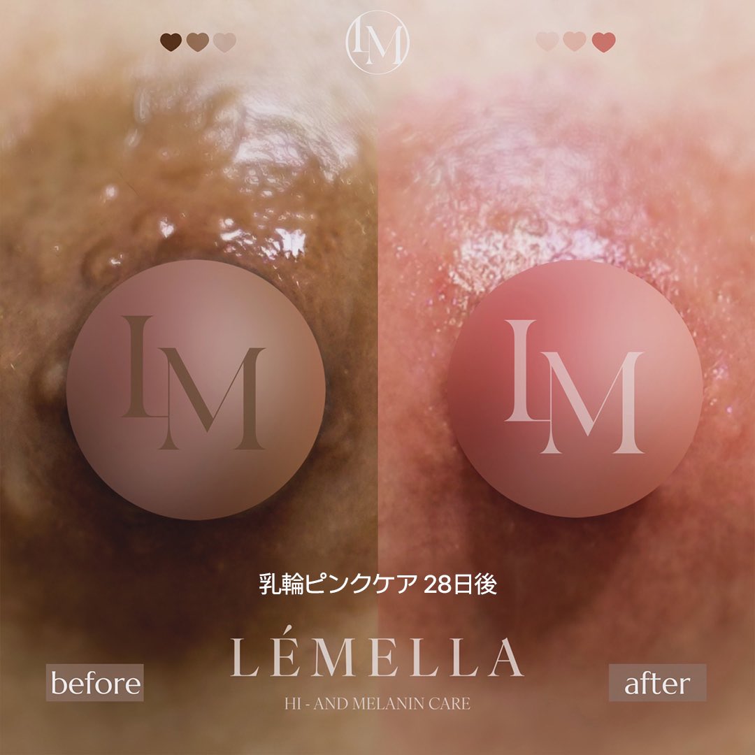 乳輪　ピンク レーザーでもなければ色素注入タトゥーでもないのに乳輪こんなピンクなる？？って疑心暗鬼だった韓国ルメラを実験がてら受けてみたから1ヶ月後にレポする。塗って拭いてパックして〜のような施術で無痛なのに効果あるか半信半疑だけど私はこの位黒ずみ抜ける  ...