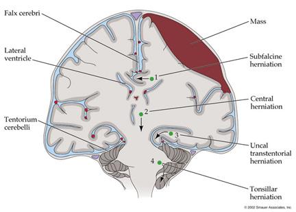 Brain herniation examples:

1. Subfalcine: Brain shifts under falx cerebri.
2. Transtentorial: Brain moves through tentorial notch.
3. Tonsillar: Cerebellar tonsils descend into foramen magnum.
4. Upward: Brainstem compresses upward.
5. Central: Both hemispheres herniate downward