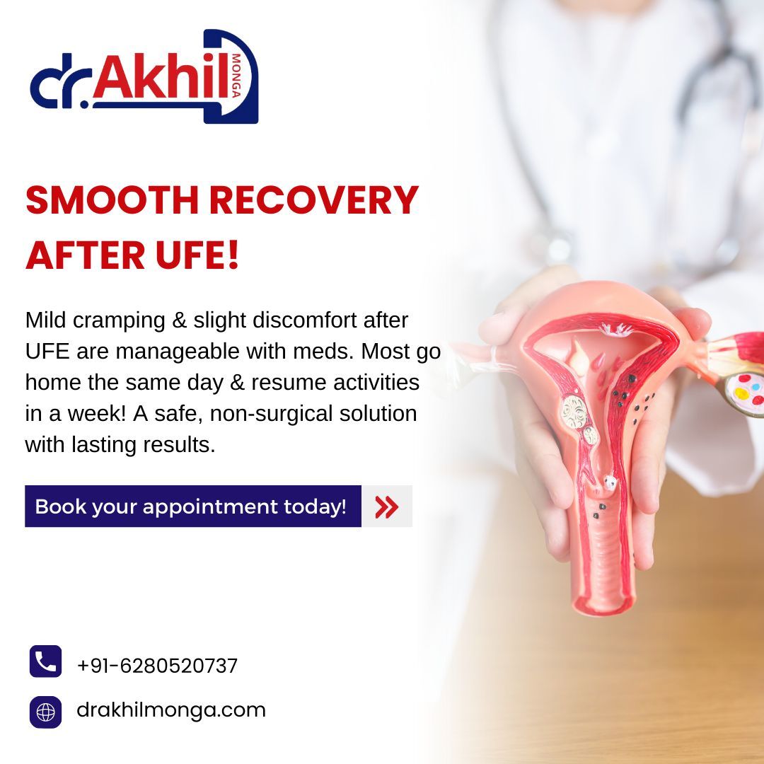 Mild cramping &amp; discomfort post-procedure are manageable with medication. Most patients return home the same day &amp; resume activities within a week! A safe, non-surgical solution with lasting effects. Book at drakhilmonga.com or call +91-6280520737 

#UFE #FibroidTreatment