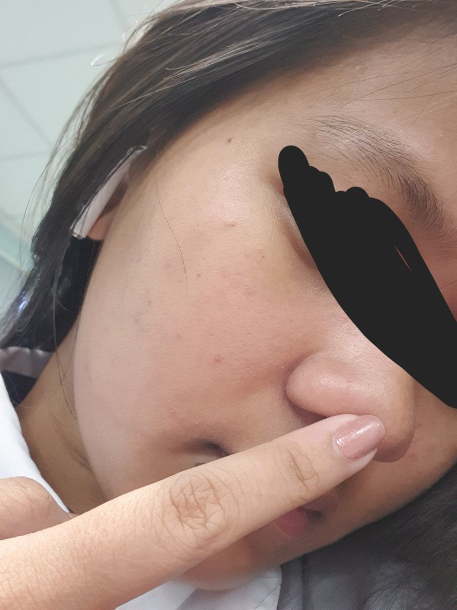anyonee_woo's tweet photo. I NEED HELP PLS HUHUHU can someone reco a sunscreen that will work for someone like me who has a skin asthma 😭 i used the 2 o's sunscreen and it made my skin have tiny red bumps all over my face 🙁 https://t.co/Zkzk1YhNJb