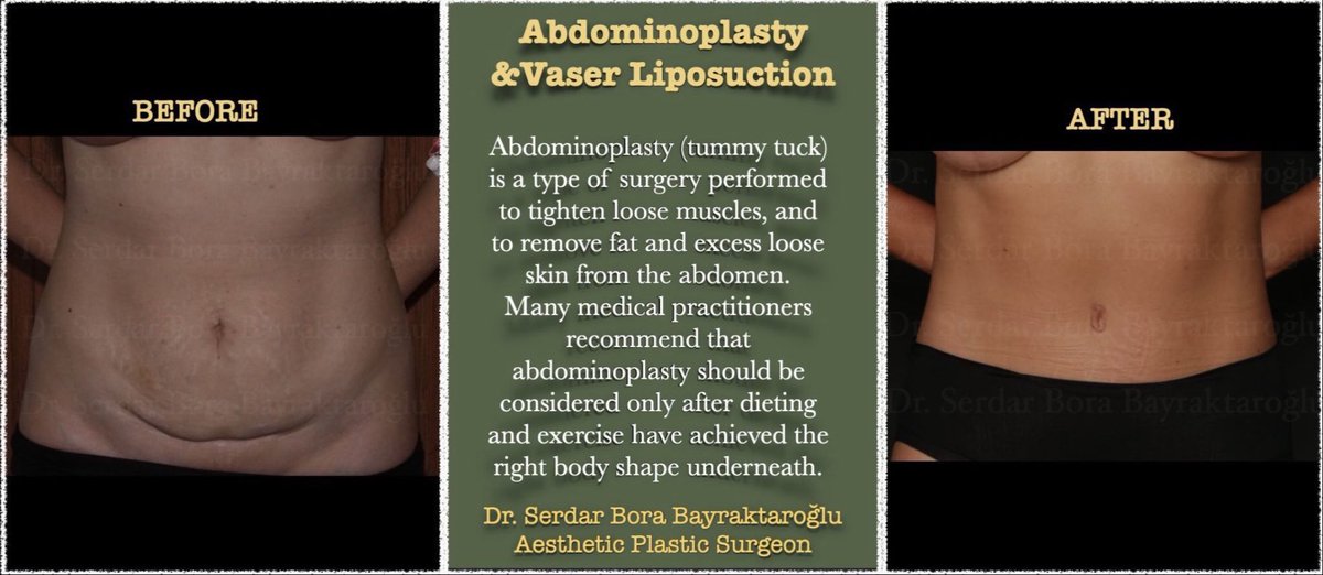 Clinicsbbintl's tweet photo. ABDOMINOPLASTY &amp; VASER LIPOSUCTION

You can have the look you want with tummy tuck and vaser liposuction surgeries.
#clinicsbb #clinicsbbinternational #aestheticsurgery #plasticsurgery  #abdominoplasty #vaserliposuction #liposuction #vaserlipo #lipo #tummytuck #new https://t.co/LNJaIYSDRl