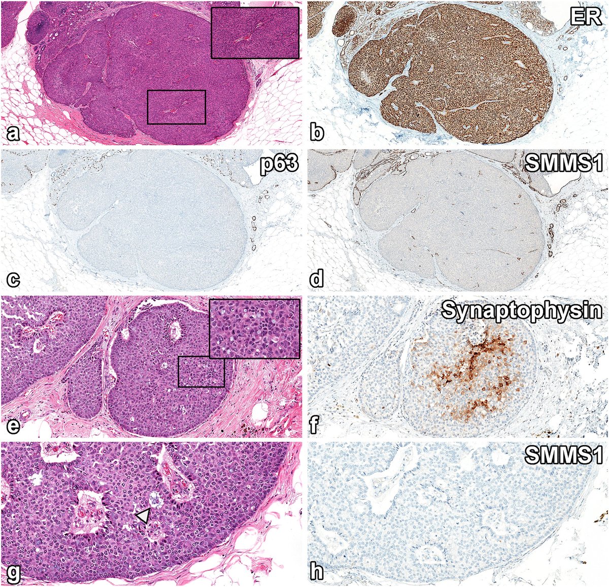 Hannah Wen (@hannahywen) on Twitter photo Delighted to share our latest article, "Challenges in papillary tumors of breast", published with my wonderful colleague <a href="/RazaHoda/">Raza Hoda MD</a> in <a href="/Human_Pathology/">Human Pathology</a>! It's always a joy working together. Check it out here sciencedirect.com/science/articl… Delighted to share our latest article, "Challenges in papillary tumors of breast", published with my wonderful colleague <a href="/RazaHoda/">Raza Hoda MD</a> in <a href="/Human_Pathology/">Human Pathology</a>! It's always a joy working together. Check it out here sciencedirect.com/science/articl…