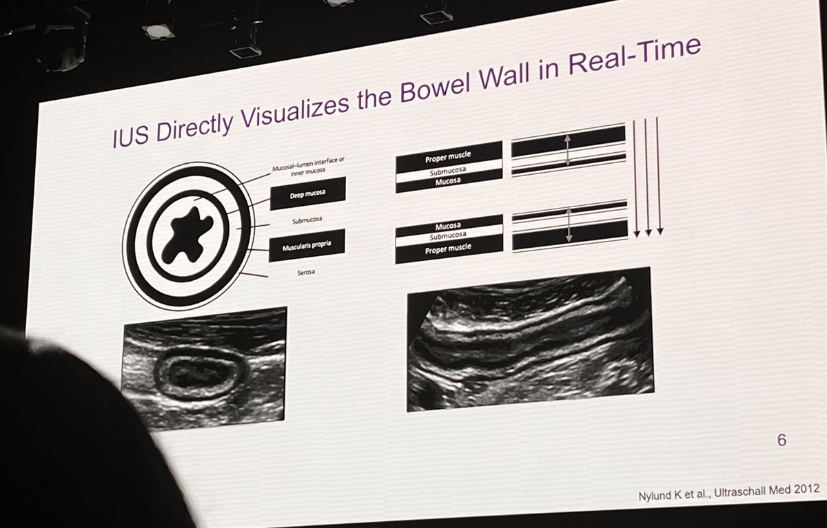 Sotirios G Doukas MD PhD (@sdoukasmd) on Twitter photo An other great talk by <a href="/DrMikeDolinger/">Michael Todd Dolinger, MD MBA</a> on IUS utility for #IBD at Big Gut #NYU <a href="/nyulangone/">NYU Langone Health</a>
🙌🏻Great for special populations: Pregnancy, Peds, and Elderly
Consider IUS checkpoints:
🚨Diagnosis
💉Rx response
✅Maintenance
🔥Flare An other great talk by <a href="/DrMikeDolinger/">Michael Todd Dolinger, MD MBA</a> on IUS utility for #IBD at Big Gut #NYU <a href="/nyulangone/">NYU Langone Health</a>
🙌🏻Great for special populations: Pregnancy, Peds, and Elderly
Consider IUS checkpoints:
🚨Diagnosis
💉Rx response
✅Maintenance
🔥Flare