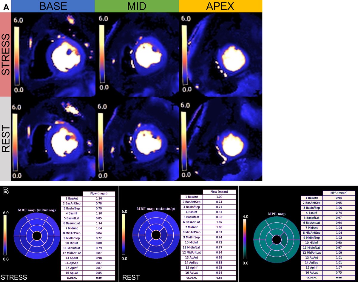 RadioGraphics (@radiographics) on Twitter photo Quantitative stress perfusion cardiac MRI đź«€ is emerging as a powerful noninvasive tool for evaluating CAD, microvascular dysfunction, aortic stenosis, and allograft vasculopathy. <a href="/Robi_Catania/">Roberta Catania</a> <a href="/NURadiology/">Northwestern Radiology</a> @DrSandraQuinn <a href="/a_rahsepar/">Amir A Rahsepar</a> @bdallen6 bit.ly/3Fz0xq6 Quantitative stress perfusion cardiac MRI đź«€ is emerging as a powerful noninvasive tool for evaluating CAD, microvascular dysfunction, aortic stenosis, and allograft vasculopathy. <a href="/Robi_Catania/">Roberta Catania</a> <a href="/NURadiology/">Northwestern Radiology</a> @DrSandraQuinn <a href="/a_rahsepar/">Amir A Rahsepar</a> @bdallen6 bit.ly/3Fz0xq6
