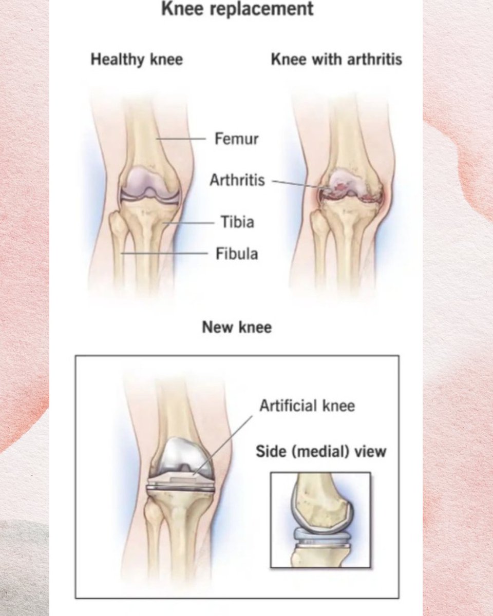 opstandwalkrun's tweet photo. Fun facts about knee replacement surgery.
🔹 Over 90% of knee replacement patients experience major pain relief and improved mobility.
🔹 Modern knee implants can last 15 - 20 years.
🔹 Many patients start walking within 24 hours of surgery with the help of a walker or crutches. https://t.co/TUVs0zdban