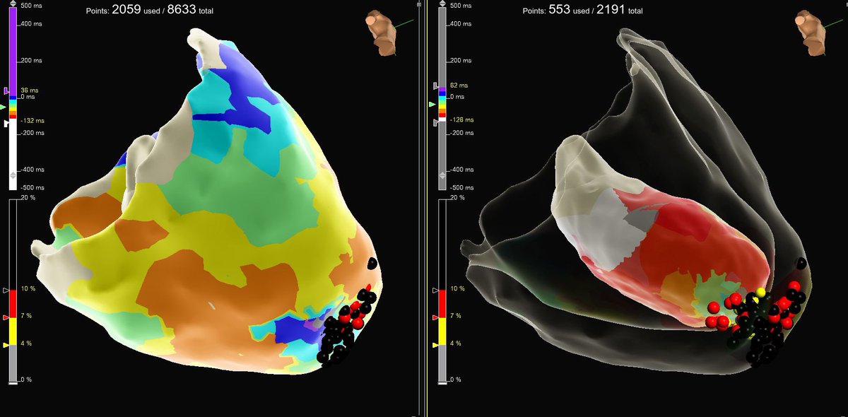 Mert İlker Hayıroğlu (@mertilkerh) on Twitter photo Loss of epicardial late potentials after endocardial ablation, pre- and post-ILAM, with ablation also applied from the epicardial side in the case. #ablateVT great maps from <a href="/NurigunayEP/">Nuri Günay</a> #Epeeps Loss of epicardial late potentials after endocardial ablation, pre- and post-ILAM, with ablation also applied from the epicardial side in the case. #ablateVT great maps from <a href="/NurigunayEP/">Nuri Günay</a> #Epeeps