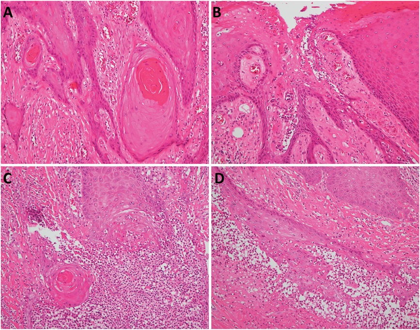 AJDP_Journal's tweet photo. #ClinicalPathologicChallenge
66YM with poorly controlled diabetes mellitus p/w a sinus-forming polypoid firm nodule on the right scrotal skin. It was slightly tender and oozing yellow paste-like debris material from the surface openings.
IHC: CK5/6 in Fig 4(A,B,C), SMA in Fig 4D https://t.co/D4PFrwTW5L