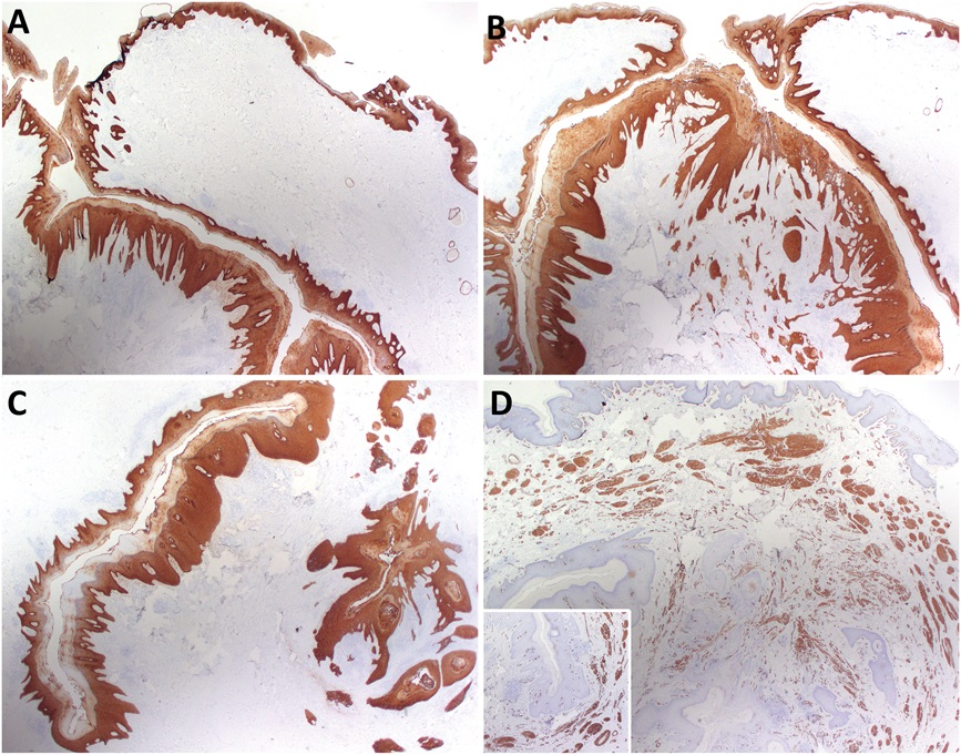 AJDP_Journal's tweet photo. #ClinicalPathologicChallenge
66YM with poorly controlled diabetes mellitus p/w a sinus-forming polypoid firm nodule on the right scrotal skin. It was slightly tender and oozing yellow paste-like debris material from the surface openings.
IHC: CK5/6 in Fig 4(A,B,C), SMA in Fig 4D https://t.co/D4PFrwTW5L