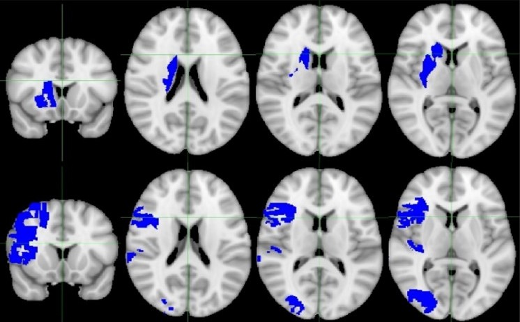 Journal of Neuroimaging (@jneuroimaging) on Twitter photo Parenchymal Hematoma After Endovascular Thrombectomy Is Associated With Pretreatment Basal Ganglia Infarct Volume
onlinelibrary.wiley.com/doi/full/10.11…
#neuroimaging #neurology #neurotwitter #neuroscience #neurorad #radres <a href="/WileyNeuro/">Wiley Neuro</a> <a href="/asneuroimaging/">American Society of Neuroimaging</a> #stroke #thrombectomy #hematoma Parenchymal Hematoma After Endovascular Thrombectomy Is Associated With Pretreatment Basal Ganglia Infarct Volume
onlinelibrary.wiley.com/doi/full/10.11…
#neuroimaging #neurology #neurotwitter #neuroscience #neurorad #radres <a href="/WileyNeuro/">Wiley Neuro</a> <a href="/asneuroimaging/">American Society of Neuroimaging</a> #stroke #thrombectomy #hematoma
