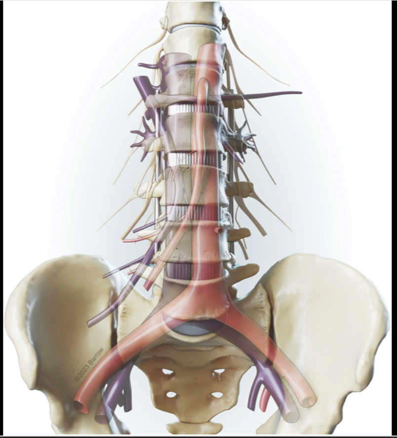 Neurosurgery Publications (@neurosurgerycns) on Twitter photo #NEUNew Clinical Outcomes and Radiographic Results of Prone Transpsoas Lateral Lumbar Interbody Fusion: A Single-Institution Case Series bit.ly/3E60cuA by <a href="/Ehresman_J/">Jeff Ehresman</a> et al <a href="/BarrowNeuro/">BarrowNeurological</a> <a href="/CNS_Update/">CNS</a> <a href="/JohnHShinMD/">John H. Shin MD, MBA</a> <a href="/george_maragkos/">George Maragkos, MD</a> <a href="/DKondziolkaCNS/">Douglas Kondziolka</a> #NEUNew Clinical Outcomes and Radiographic Results of Prone Transpsoas Lateral Lumbar Interbody Fusion: A Single-Institution Case Series bit.ly/3E60cuA by <a href="/Ehresman_J/">Jeff Ehresman</a> et al <a href="/BarrowNeuro/">BarrowNeurological</a> <a href="/CNS_Update/">CNS</a> <a href="/JohnHShinMD/">John H. Shin MD, MBA</a> <a href="/george_maragkos/">George Maragkos, MD</a> <a href="/DKondziolkaCNS/">Douglas Kondziolka</a>