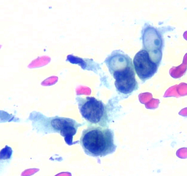 Lola Lozano (@mdlozanoe) on Twitter photo "The bull's eye": Intracytoplasmic vacuoles outlined by thick cytoplasm containing a dot of inspisated mucin in the center: Breast Cancer (in this case metastatic to a mediastinal LN) #Cytopath <a href="/IACytology/">International Academy Cytology</a> <a href="/SECitologia/">Sociedad Española de Citología</a> <a href="/EfcsYoung/">Young EFCS</a> <a href="/ESP_Pathology/">European Society of Pathology (ESP)</a> <a href="/cytopathology/">Cytopathology.org</a> <a href="/SEAP_IAP/">SEAP-IAP</a> "The bull's eye": Intracytoplasmic vacuoles outlined by thick cytoplasm containing a dot of inspisated mucin in the center: Breast Cancer (in this case metastatic to a mediastinal LN) #Cytopath <a href="/IACytology/">International Academy Cytology</a> <a href="/SECitologia/">Sociedad Española de Citología</a> <a href="/EfcsYoung/">Young EFCS</a> <a href="/ESP_Pathology/">European Society of Pathology (ESP)</a> <a href="/cytopathology/">Cytopathology.org</a> <a href="/SEAP_IAP/">SEAP-IAP</a>