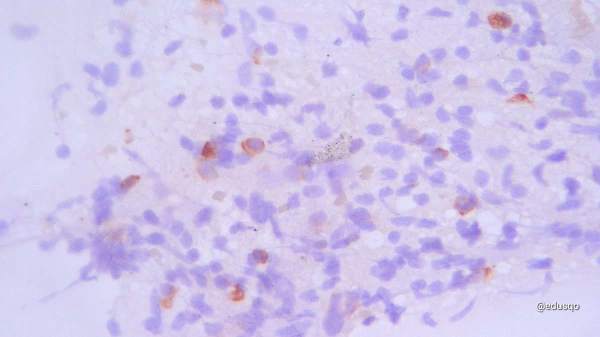 edusqo's tweet photo. It was almost a normal lymph node sample while #ROSE assessment, but...
▫️Epithelioid binucleated cell was too suspicious.
▫️Cytokeratin was positive on isolated cells.
▫️#CellBlock is always mandatory for #IHCPath.
▫️Medullary thyroid carcinoma Mx.
#HemePath #CytoPath #FNAFriday https://t.co/iqrdzm8DEm