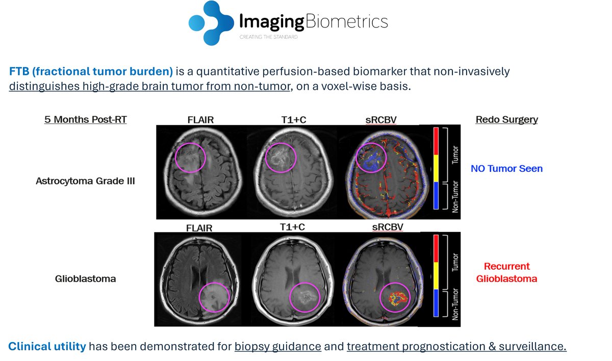 IQ-AI - Imaging Biometrics (@iqai_ib) on Twitter photo We've been busy upgrading existing clients to FTB Express processing. Fully automated and validated, FTBx (DSC-FTB) maps greatly simplify the interpretation of challenging cases - increasing inter-reader agreement and confidence.
<a href="/AlMusella/">Al Musella</a> <a href="/TheASNR/">The American Society of Neuroradiology</a> <a href="/NeuroOnc/">SNO</a> <a href="/theABTA/">American Brain Tumor Association</a> <a href="/NBTStweets/">National Brain Tumor Society</a> We've been busy upgrading existing clients to FTB Express processing. Fully automated and validated, FTBx (DSC-FTB) maps greatly simplify the interpretation of challenging cases - increasing inter-reader agreement and confidence.
<a href="/AlMusella/">Al Musella</a> <a href="/TheASNR/">The American Society of Neuroradiology</a> <a href="/NeuroOnc/">SNO</a> <a href="/theABTA/">American Brain Tumor Association</a> <a href="/NBTStweets/">National Brain Tumor Society</a>