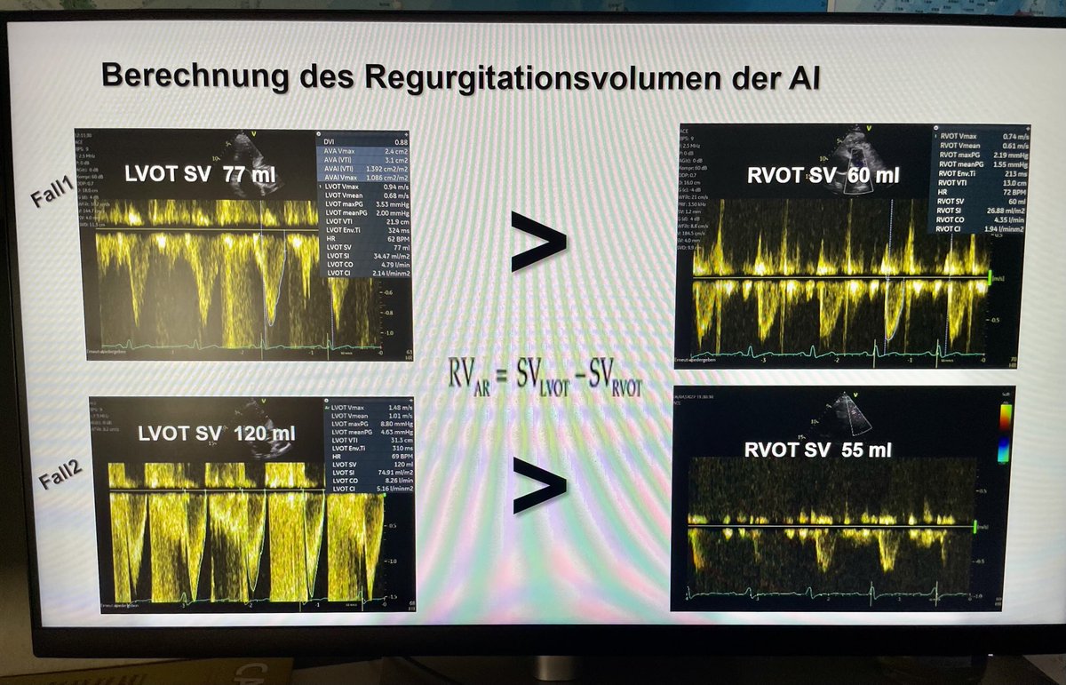 Wie erklärt man isolierte AI im Echo #echofirst Diese Methode funktioniert auch bei kombinierten Insuffizienz Vitien ⁦<a href="/DHZB_Akademie/">DHZB Akademie</a>⁩ ⁦<a href="/dhzcharite/">Deutsches Herzzentrum der Charité</a>⁩