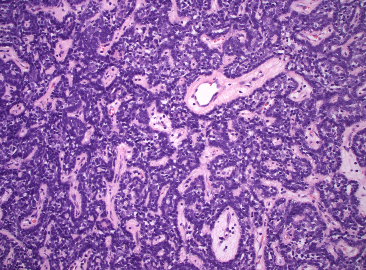 70s M thigh mass. Dx?

#PathTwitter #PathX