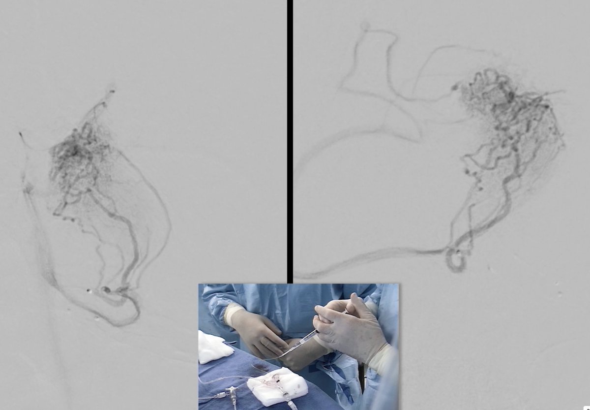 Daniel Vela-Duarte, MD (@danielvelamd) on Twitter photo Day 2
Another interesting, rare case of a 16-year-old patient with a ruptured microAVM of the caudate nucleus, supplied by the Artery of Heubner.
Why would this AVM rupture: Spontaneous thrombosis of the draining vein?
#LINNCamericas <a href="/LINNConline/">LINNC online 🧠</a> Day 2
Another interesting, rare case of a 16-year-old patient with a ruptured microAVM of the caudate nucleus, supplied by the Artery of Heubner.
Why would this AVM rupture: Spontaneous thrombosis of the draining vein?
#LINNCamericas <a href="/LINNConline/">LINNC online 🧠</a>