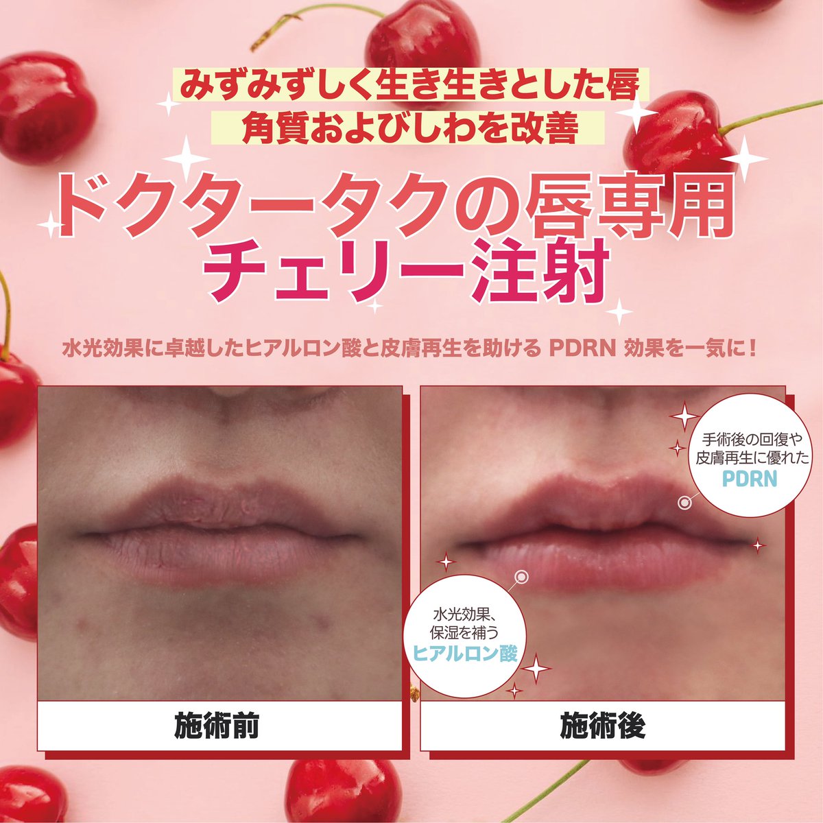dr_tak_ps's tweet photo. ⋆⸜ 𝓝𝓮𝔀 ⸝⋆  ドクタータク整形外科
🧚✨🍒チェリー注射🍒✨🧚
続々とレビューいただいております😍💋
ご興味ございましたら下記リンクよりご連絡くださいませ🩵💁‍♀️
お問い合わせ📩
LINE➰https://t.co/UnbPMtrkNG
#内側人中短縮 #口角挙上  #外側人中短縮 #M字リップ  #韓国整形 #Cカール https://t.co/isTH0degC4