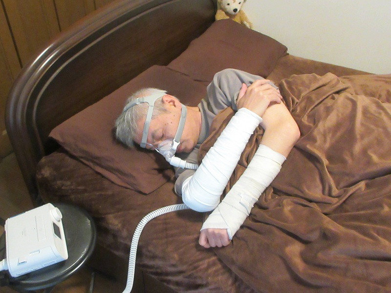 oscarexpress's tweet image. あれからシーパップ使い続けています。が、両腕を固定された状態でマスク着けると見た目がかなり悲惨なんですよね。先日は肋骨の方のバストバンドも外れ、来週は左手首のが今より小さな装具に付け替え予定。順調です。
#CPAP #睡眠時無呼吸症候群