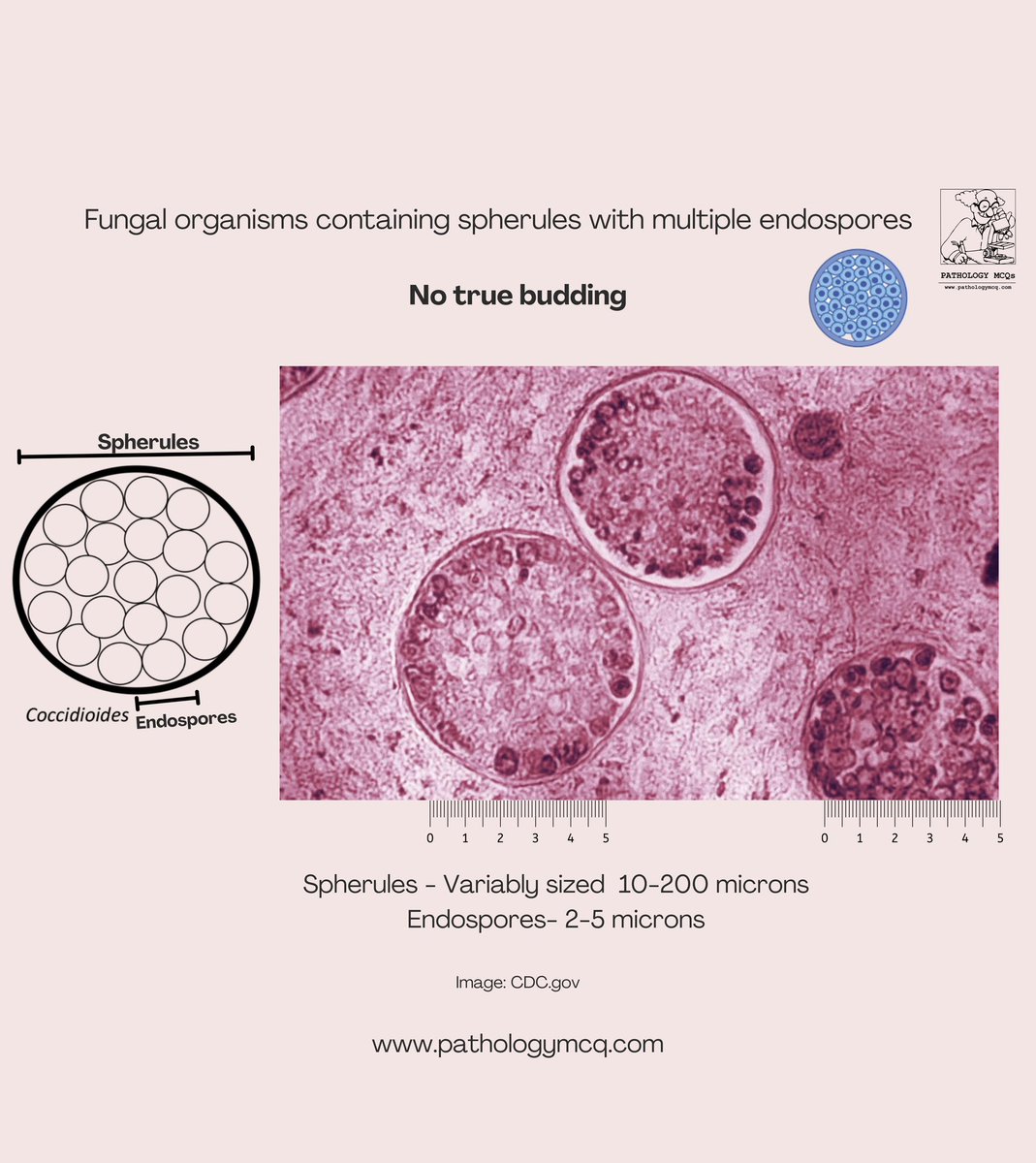 Think all yeasts are the same? Think again.
From narrow-based budding of Cryptococcus and Histoplasma to the spherules of Coccidioides and the iconic “Mickey Mouse” appearance of Paracoccidioides, these pathogens have distinct morphologies that every pathologist must recognize.