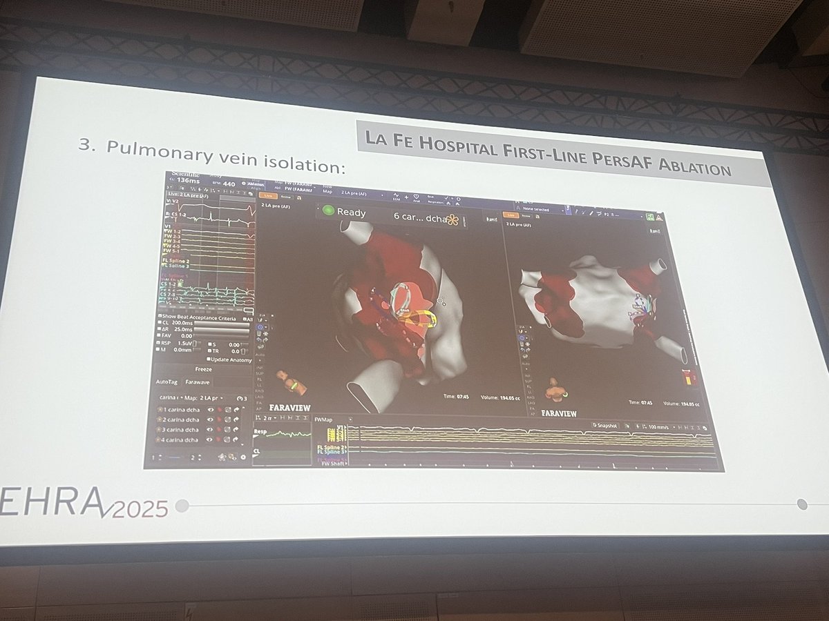 Dominik Linz (@dominik_linz) on Twitter photo #EHRA2025
Interesting!
This will impact my next FaraPulse PFA procedures from next week on!
Carina is often a region of reversible electroporationโฆ (also documented in re-mapping studiesโฆ)
๐๐ป An extra PFA application on the Carina may help here!
<a href="/SergeBoveda/">Serge Boveda</a> <a href="/Phiso_de/">Philipp Sommer</a> #EHRA2025
Interesting!
This will impact my next FaraPulse PFA procedures from next week on!
Carina is often a region of reversible electroporationโฆ (also documented in re-mapping studiesโฆ)
๐๐ป An extra PFA application on the Carina may help here!
<a href="/SergeBoveda/">Serge Boveda</a> <a href="/Phiso_de/">Philipp Sommer</a>