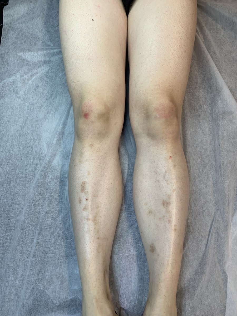 🔥 더워지는 날씨, 지금은 다리 왁싱할 때 🦵✨

✓ 남자 원장님의 1:1 맞춤 예약 관리
✓ 시술 후 모든 기구, 용품 소독 및 1회 용품 사용
✓ 샤워실 완비
​✓ 당일 예약 가능

 문의 : open.kakao.com/o/sXF03Mzf

#인천남자왁싱 #남자왁서 #인하대 #부평 #주안 #송도 #제물포 #청라