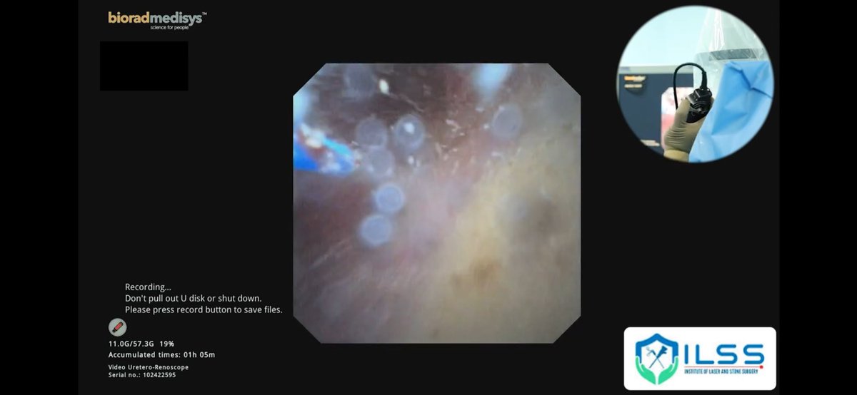 SHEATHLESS RIRS USING 6.3F INDOSCOPE SLEEKER AND QUANTINO TFL LASER (SEM... youtu.be/oq8I79mx8D8?si… via <a href="/YouTube/">YouTube</a>