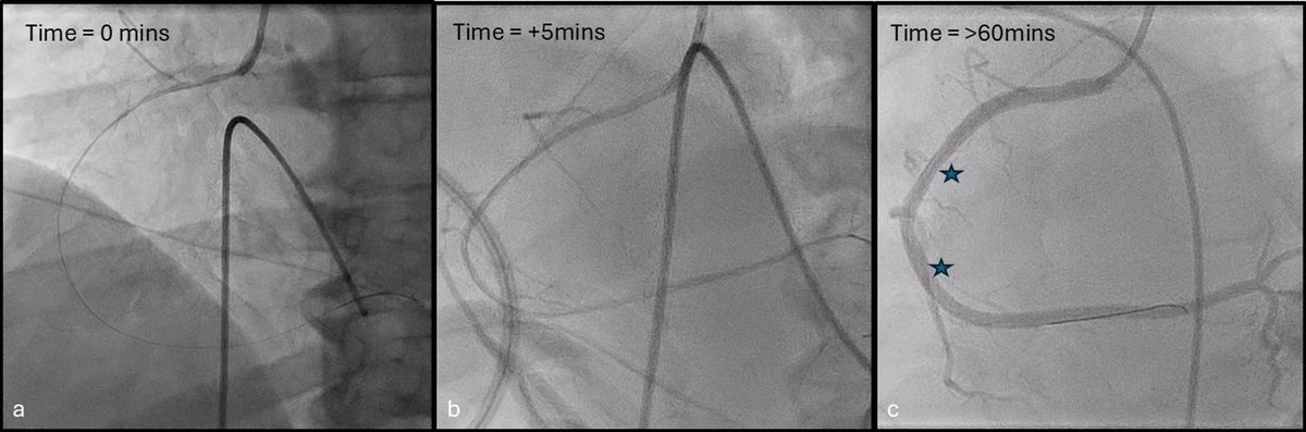 Justin Chiong (@justinchiong_) on Twitter photo Can PFA mediated haemolysis result in severe diffuse coronary vasospasm?
Now available open access - <a href="/hrs_journal/">HeartRhythm</a>
<a href="/vish_luther/">Dr Vishal Luther</a> <a href="/DhirajGuptaBHRS/">Prof Dhiraj Gupta</a> <a href="/jdinaus/">John Hung</a> <a href="/simonmodi/">Simon Modi</a> <a href="/LiverpoolEP/">Liverpool Heart Rhythm</a> Can PFA mediated haemolysis result in severe diffuse coronary vasospasm?
Now available open access - <a href="/hrs_journal/">HeartRhythm</a>
<a href="/vish_luther/">Dr Vishal Luther</a> <a href="/DhirajGuptaBHRS/">Prof Dhiraj Gupta</a> <a href="/jdinaus/">John Hung</a> <a href="/simonmodi/">Simon Modi</a> <a href="/LiverpoolEP/">Liverpool Heart Rhythm</a>
